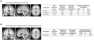 Case Report: Zolpidem’s paradoxical restorative action: A case report of functional brain imaging